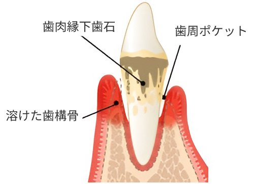 歯周炎