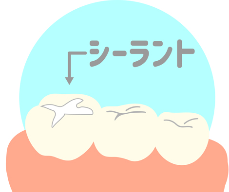 シーラント